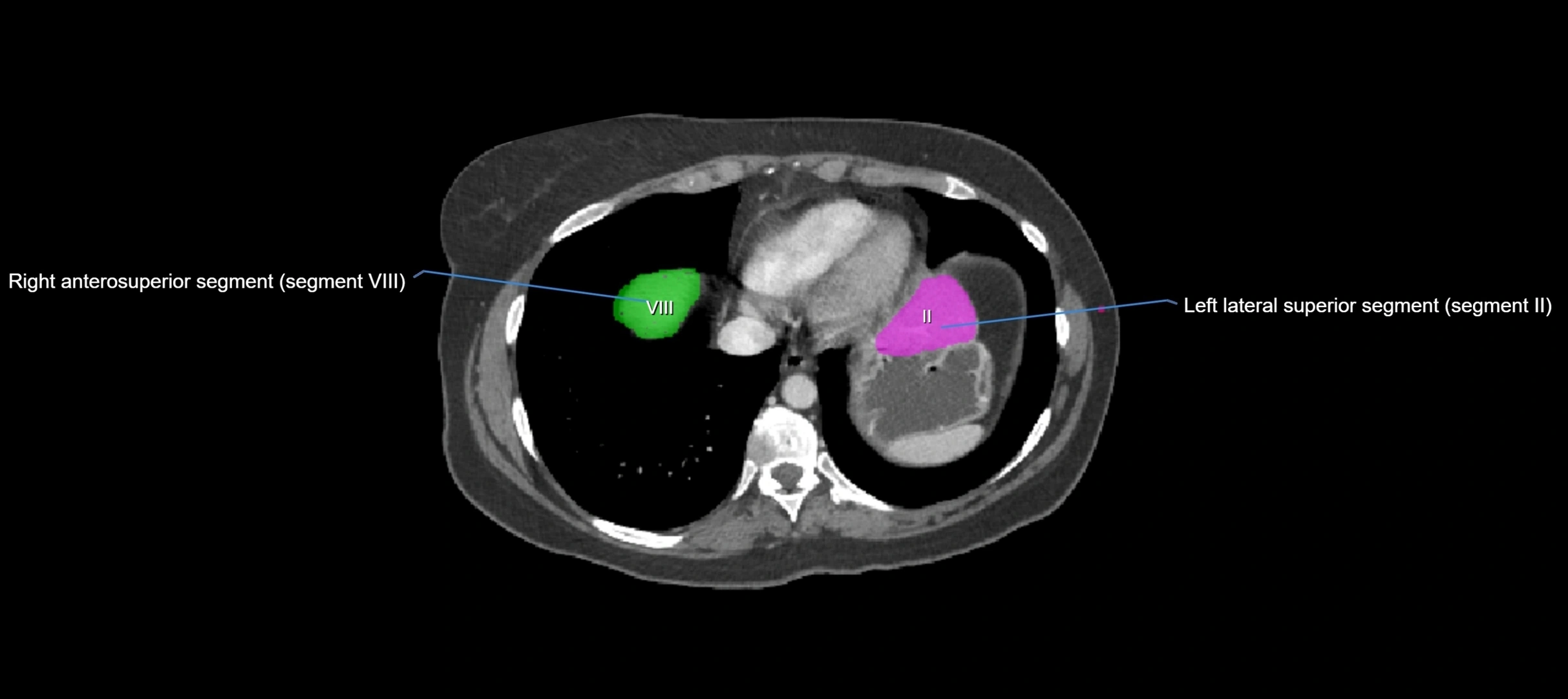 CT liver segments axial cross sectional anatomy labelled image-00075.webp